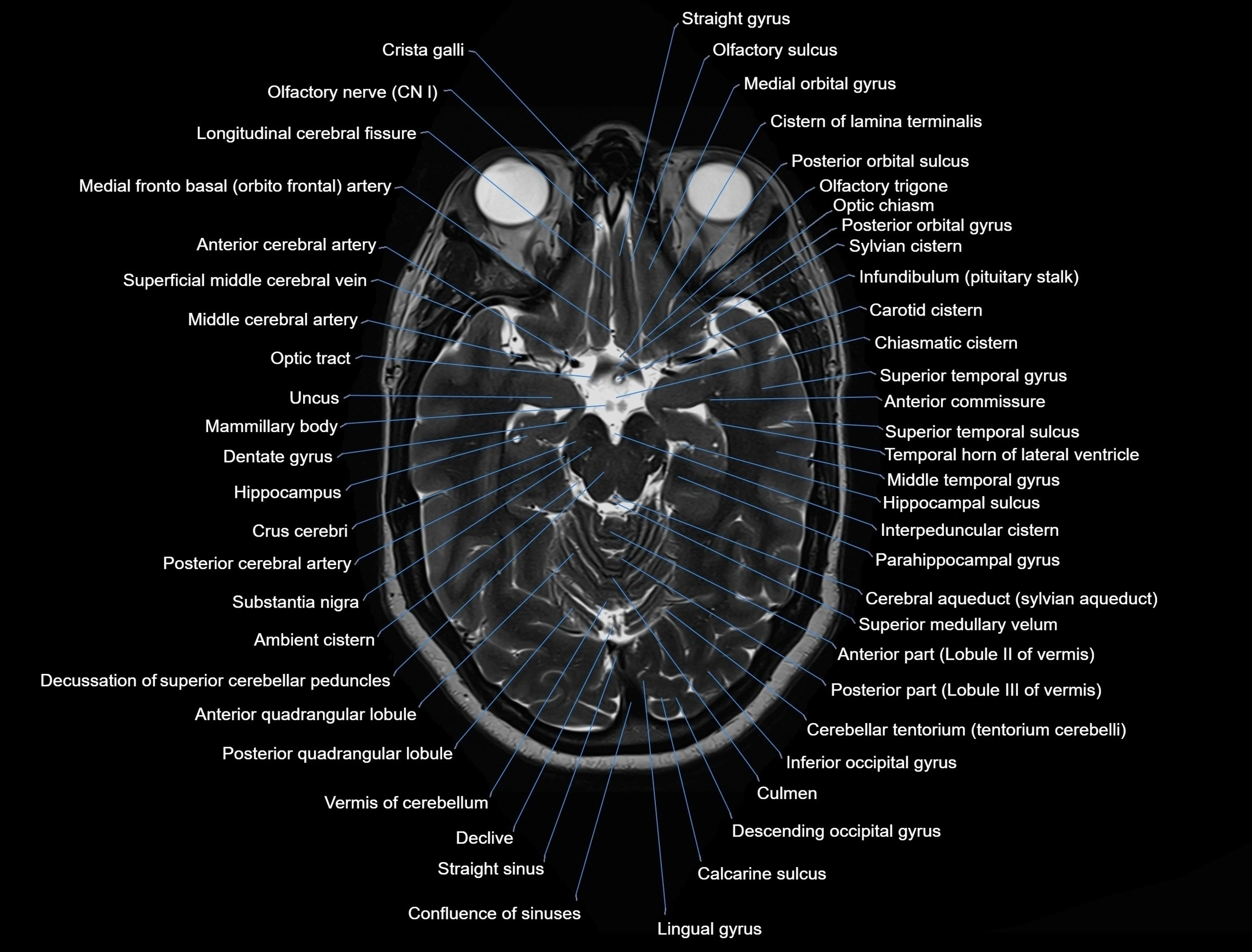 MRI Brain axial cross sectional radiology anatomy 3T image  -img-00001-00022.webp